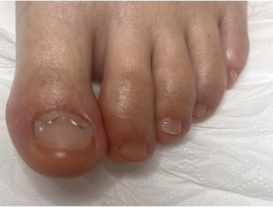 klamry na paznokcie podolog warszawa